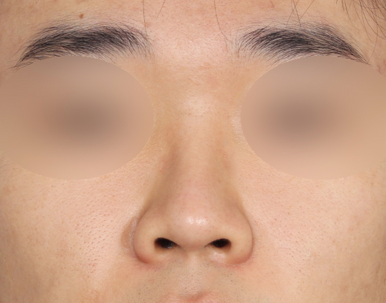 [개방형첫수술+3d맞춤보형물5.5mm+귀연골+비중격+귀뒤진피+코끝연골재배치+기능코2종(비중격,비갑개)] 전