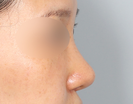 [코재개방+3d맞춤보형물4mm+실리콘제거+기증늑해제+귀연골+귀뒤진피] 후