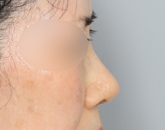 [코재개방+실리콘제거+귀연골+귀뒤진피+3d보형물3.0mm+코끝연골재배치] 후