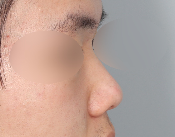 [개방형첫수술+3d맞춤보형물5.5mm+귀연골+귀뒤진피+코끝연골재배치] 전