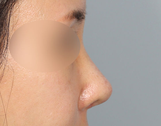[개방형첫수술+실제거+반영구피러제거+귀연골+귀뒤진피+3d맞춤보형물2.5mm+매부리+코끝연골재배치] 후