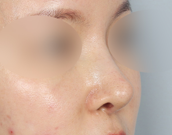[코재개방+3d맞춤보형물3.5mm] 후