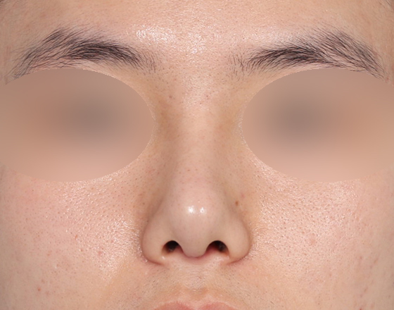 [개방형첫수술+3d맞춤보형물5.5mm+귀연골+귀뒤진피+코끝연골재배치] 후