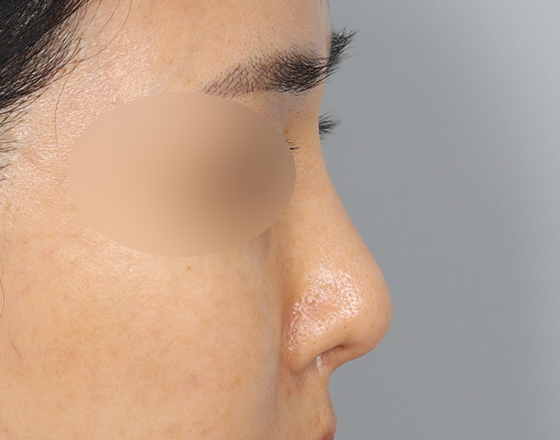 [코재수술+실리콘제거+3d맞춤보형물1.3mm] 전