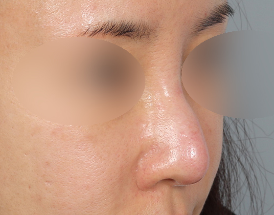 [개방형첫수술+실제거+반영구피러제거+귀연골+귀뒤진피+3d맞춤보형물2.5mm+매부리+코끝연골재배치] 전
