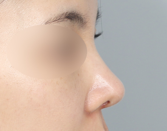 [개방형첫수술+반영구필러제거+3d맞춤보형물3.5mm+귀연골+비중격+귀뒤진피+코끝연골재배치+기능코2종(비중격,비갑개)] 후