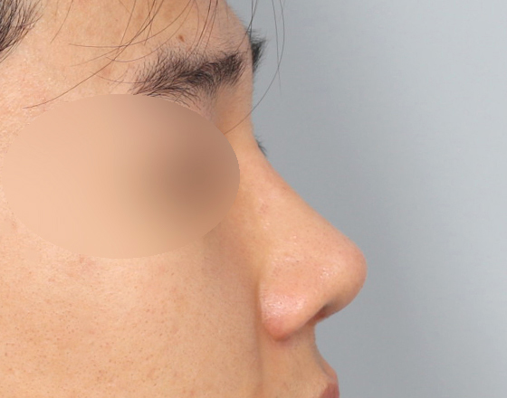 [개방형첫수술+3d맞춤보형물5.5mm+귀연골+비중격+귀뒤진피+코끝연골재배치+기능코2종(비중격,비갑개)] 후