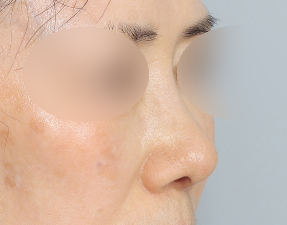 [코재개방+실리콘제거+귀연골+귀뒤진피+3d보형물3.0mm+코끝연골재배치] 후