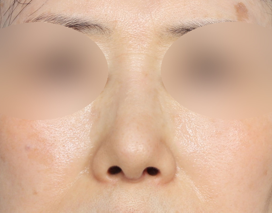 [코재개방+실리콘제거+귀연골+귀뒤진피+3d보형물3.0mm+코끝연골재배치] 후