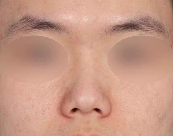 [개방형첫수술+3d맞춤보형물5.5mm+귀연골+귀뒤진피+코끝연골재배치] 전