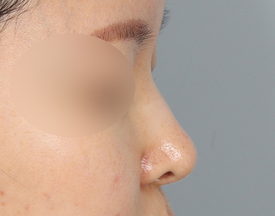[코재개방+3d맞춤보형물3.5mm] 전
