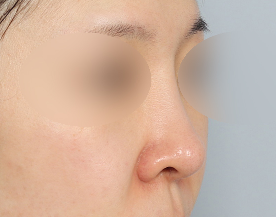 [코재수술+실리콘제거+3d맞춤보형물4mm+비중격연장해재+귀연골] 전