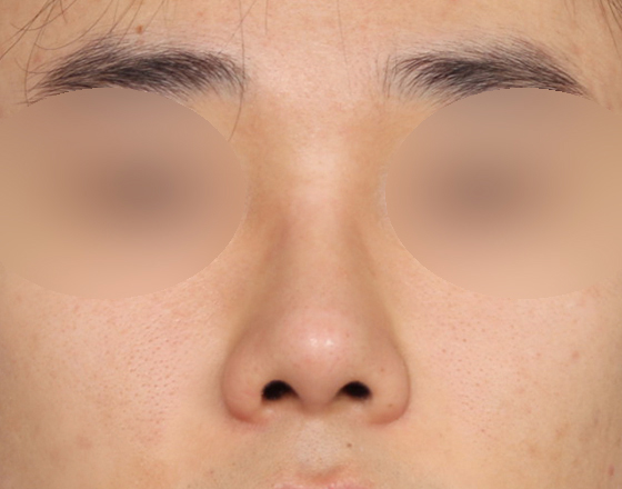 [개방형첫수술+3d맞춤보형물5.5mm+귀연골+비중격+귀뒤진피+코끝연골재배치+기능코2종(비중격,비갑개)] 후