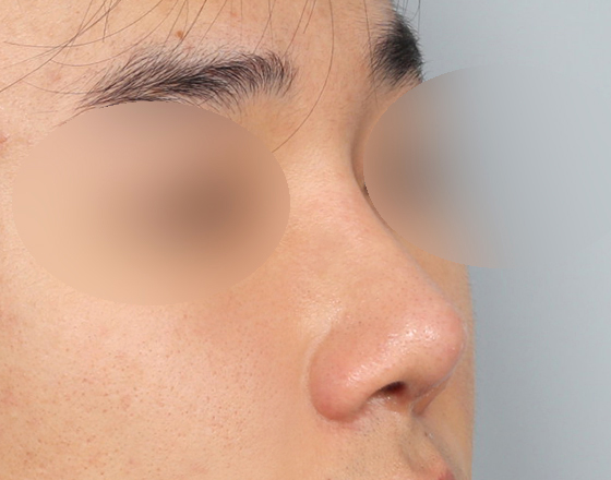 [개방형첫수술+3d맞춤보형물5.5mm+귀연골+비중격+귀뒤진피+코끝연골재배치+기능코2종(비중격,비갑개)] 후
