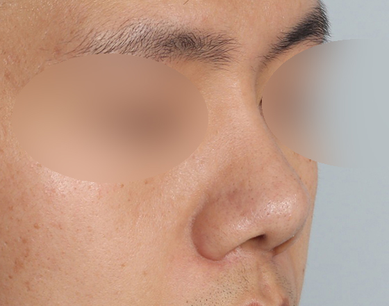 [개방형첫수술+3d맞춤보형물4.5mm+귀연골+비중격+코끝연골재배치+비주교정] 후
