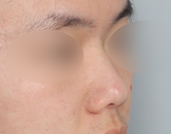 [개방형첫수술+3d맞춤보형물5.5mm+귀연골+귀뒤진피+코끝연골재배치] 전