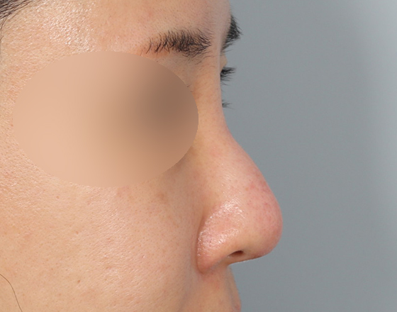 [개방형첫수술+실제거+반영구피러제거+귀연골+귀뒤진피+3d맞춤보형물2.5mm+매부리+코끝연골재배치] 전