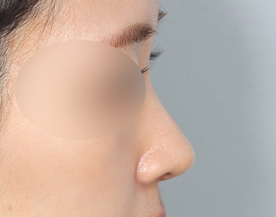 [개방형첫수술+반영구제거+무보형물+귀연골+귀뒤진피+흡수성콜라겐막+메부리+코끝연골재배치] 후