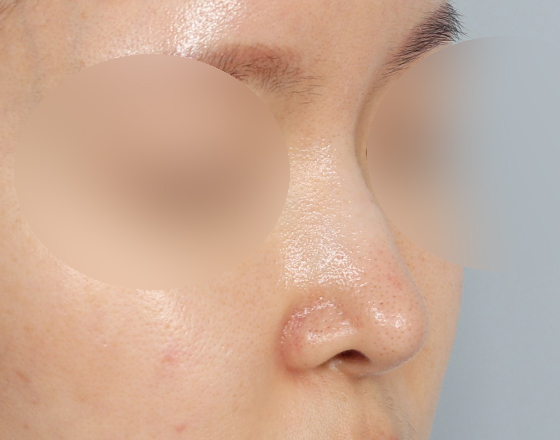 [코재개방+3d맞춤보형물3.5mm] 전