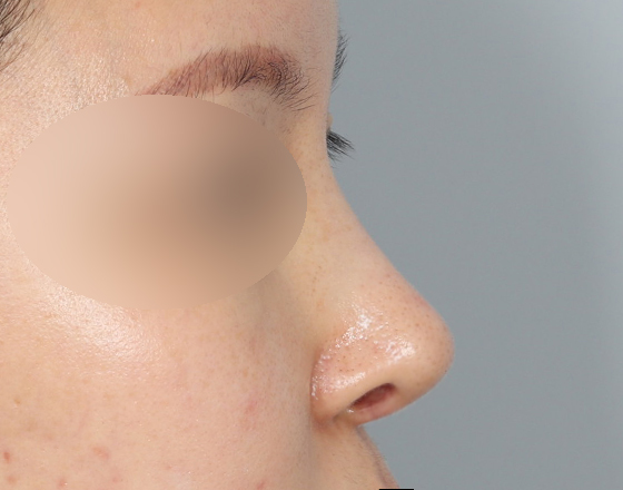 [코재개방+3d맞춤보형물3.5mm] 후