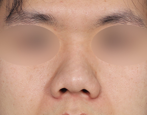 [개방형첫수술+3d맞춤보형물4.5mm+귀연골+비중격+코끝연골재배치+비주교정] 전