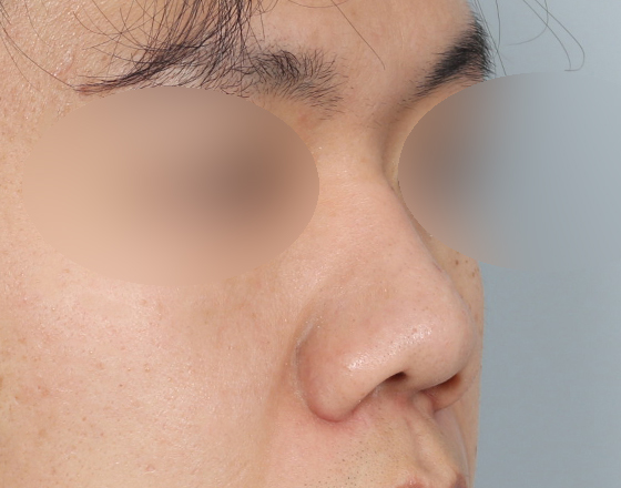 [개방형첫수술+3d맞춤보형물4.5mm+귀연골+비중격+코끝연골재배치+비주교정] 전