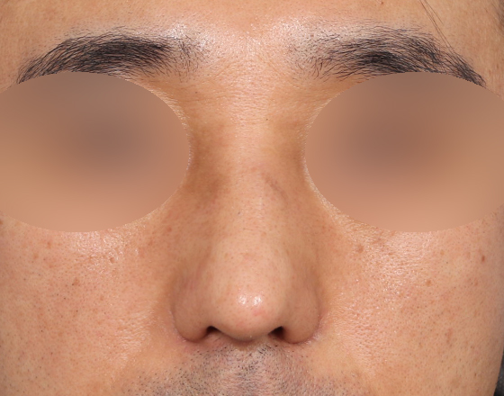 [개방형첫수술+무보형물+귀연골+비중격+귀뒤진피+흡수성콜라겐막+메부리+코끝연골재배치+기능코2종(비중격,비갑개)+절개눈매교정] 후
