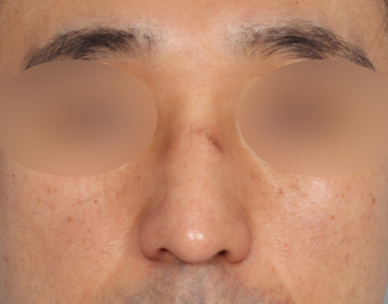 [개방형첫수술+무보형물+귀연골+비중격+귀뒤진피+흡수성콜라겐막+메부리+코끝연골재배치+기능코2종(비중격,비갑개)+절개눈매교정] 전