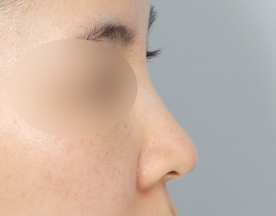 [개방형첫수술+반영구필러제거+3d맞춤보형물3.5mm+귀연골+비중격+귀뒤진피+코끝연골재배치+기능코2종(비중격,비갑개)] 전
