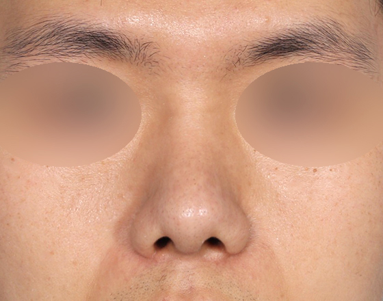 [개방형첫수술+3d맞춤보형물4.5mm+귀연골+비중격+코끝연골재배치+비주교정] 후