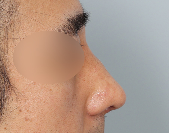 [개방형첫수술+무보형물+귀연골+비중격+귀뒤진피+흡수성콜라겐막+메부리+코끝연골재배치+기능코2종(비중격,비갑개)+절개눈매교정] 후