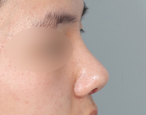 [개방형첫수술+3d맞춤보형물5.5mm+귀연골+귀뒤진피+코끝연골재배치] 후