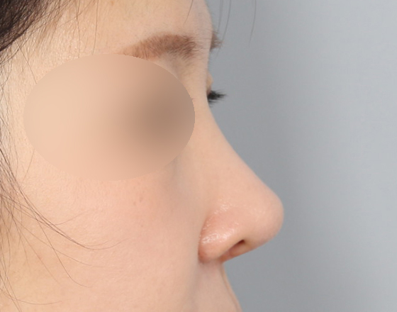 [코재수술+실리콘제거+3d맞춤보형물4mm+비중격연장해재+귀연골] 후