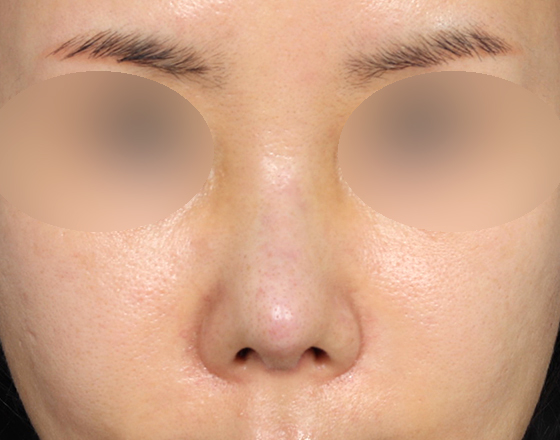 [개방형첫수술+실제거+반영구피러제거+귀연골+귀뒤진피+3d맞춤보형물2.5mm+매부리+코끝연골재배치] 후