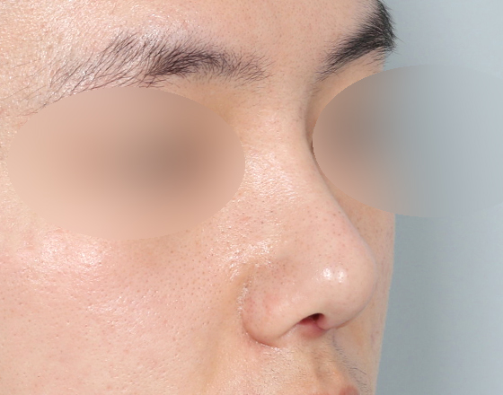 [개방형첫수술+3d맞춤보형물5.5mm+귀연골+귀뒤진피+코끝연골재배치] 후
