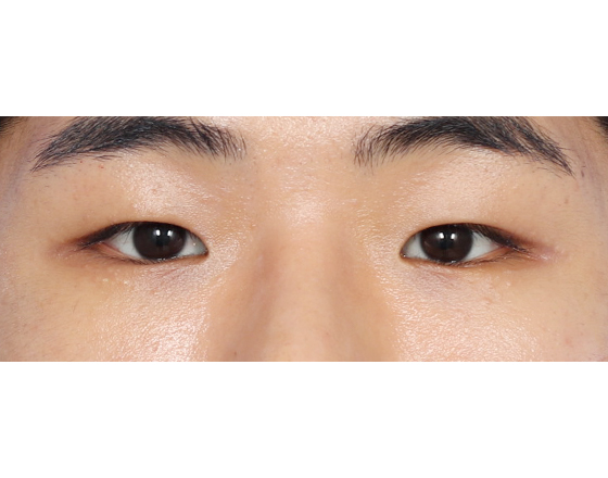 [절개눈매교정+앞트임] 전