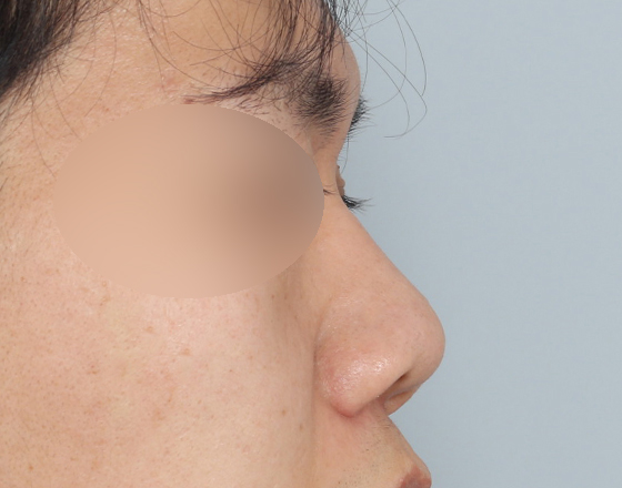 [개방형첫수술+3d맞춤보형물4.5mm+귀연골+비중격+코끝연골재배치+비주교정] 전