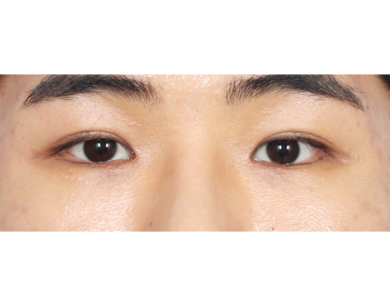 [절개눈매교정+앞트임] 후