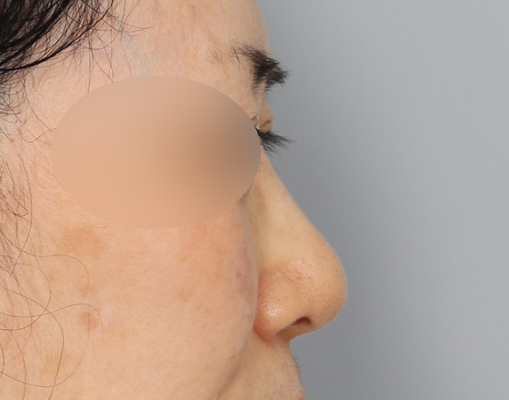 [코재개방+실리콘제거+귀연골+귀뒤진피+3d보형물3.0mm+코끝연골재배치] 전