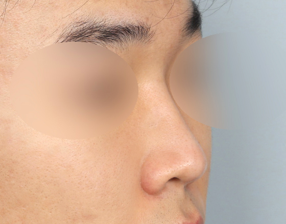 [개방형첫수술+3d맞춤보형물5.5mm+귀연골+비중격+귀뒤진피+코끝연골재배치+기능코2종(비중격,비갑개)] 전