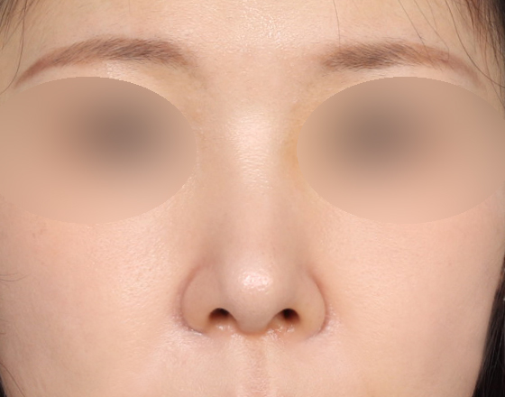 [코재수술+실리콘제거+3d맞춤보형물4mm+비중격연장해재+귀연골] 후