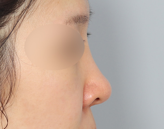 [코재수술+실리콘제거+3d맞춤보형물4mm+비중격연장해재+귀연골] 전