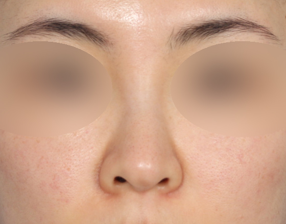 [개방형첫수술+반영구필러제거+3d맞춤보형물3.5mm+귀연골+비중격+귀뒤진피+코끝연골재배치+기능코2종(비중격,비갑개)] 전