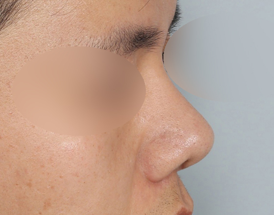 [개방형첫수술+3d맞춤보형물4.5mm+귀연골+비중격+코끝연골재배치+비주교정] 후