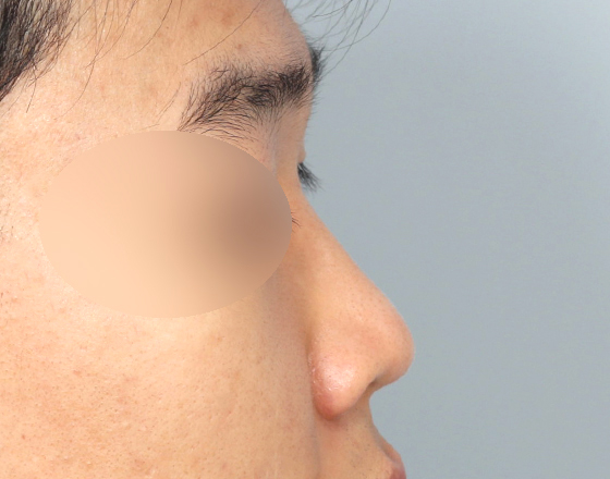 [개방형첫수술+3d맞춤보형물5.5mm+귀연골+비중격+귀뒤진피+코끝연골재배치+기능코2종(비중격,비갑개)] 전
