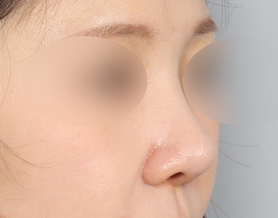 [코재수술+실리콘제거+3d맞춤보형물4mm+비중격연장해재+귀연골] 후
