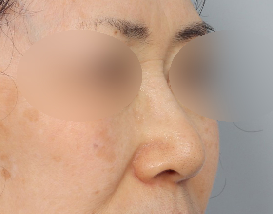 [코재개방+실리콘제거+귀연골+귀뒤진피+3d보형물3.0mm+코끝연골재배치] 전