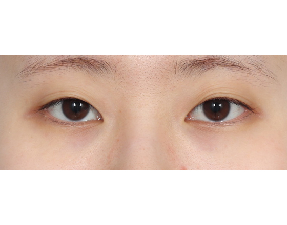 [비절개 자연유착] 전