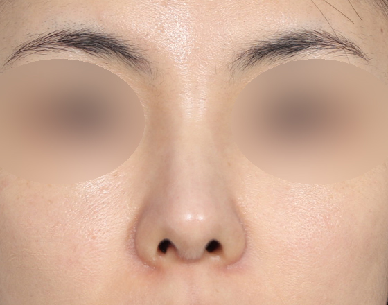 [개방형첫수술+반영구필러제거+3d맞춤보형물3.5mm+귀연골+비중격+귀뒤진피+코끝연골재배치+기능코2종(비중격,비갑개)] 후