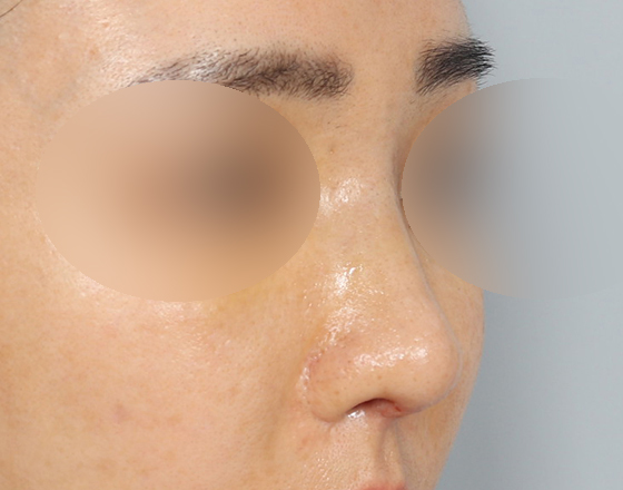 [코재수술+실리콘제거+3d맞춤보형물1.3mm] 후